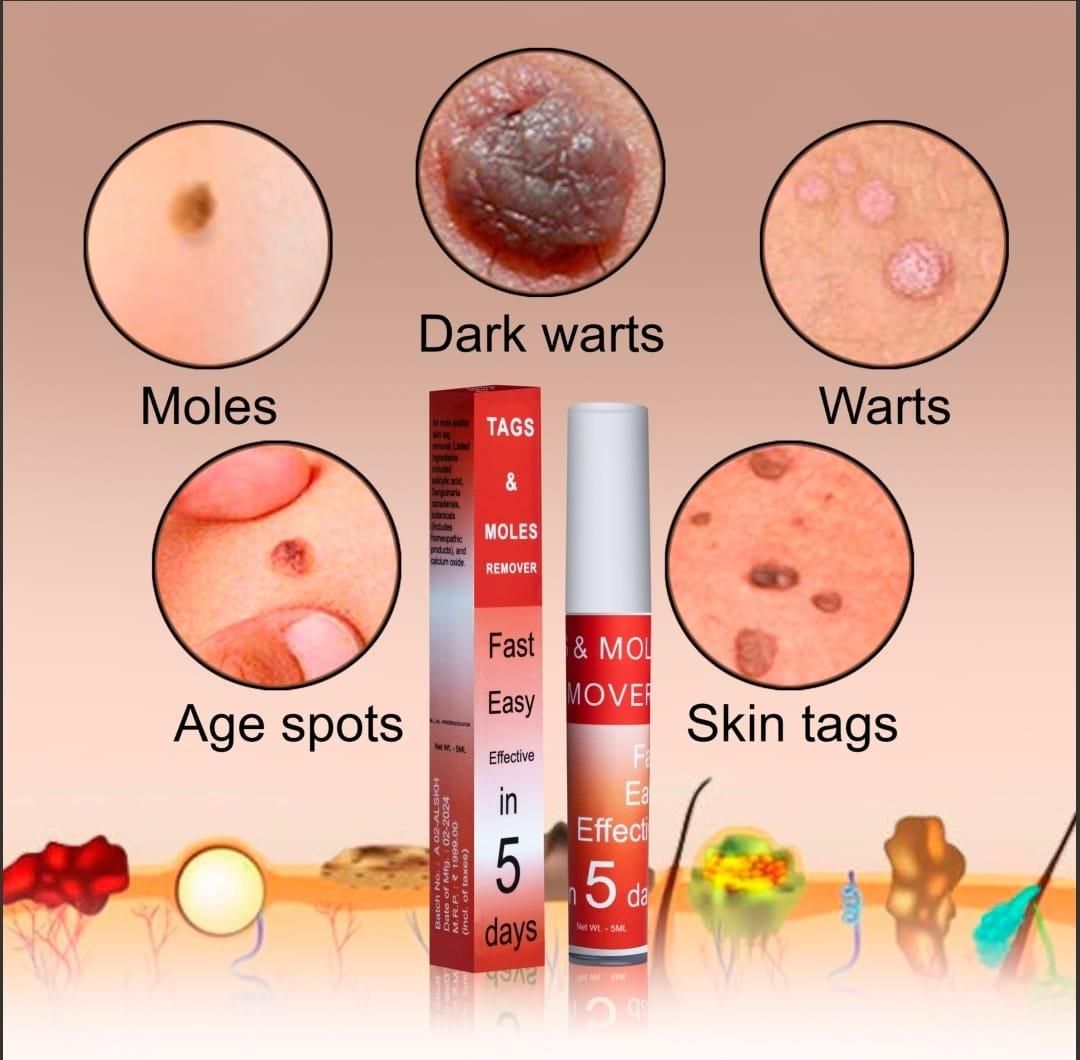 Tags & Moles Remover ( 🔥  Buy 1 Get 1 Free 🔥 )