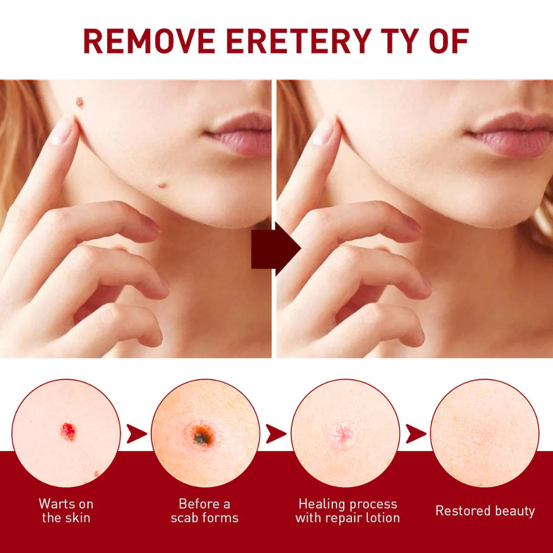 Tags & Moles Remover ( 🔥  Buy 1 Get 1 Free 🔥 )